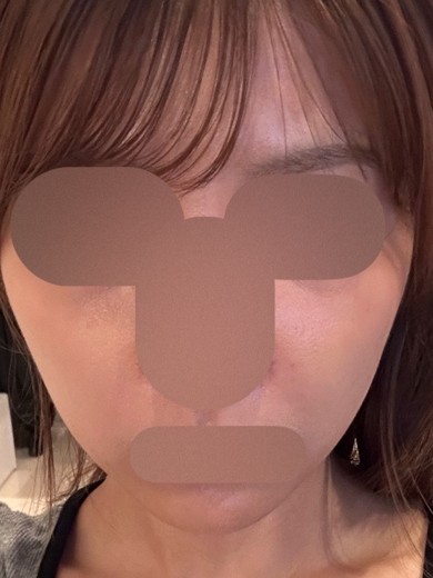 after photo: 美容注射・点滴