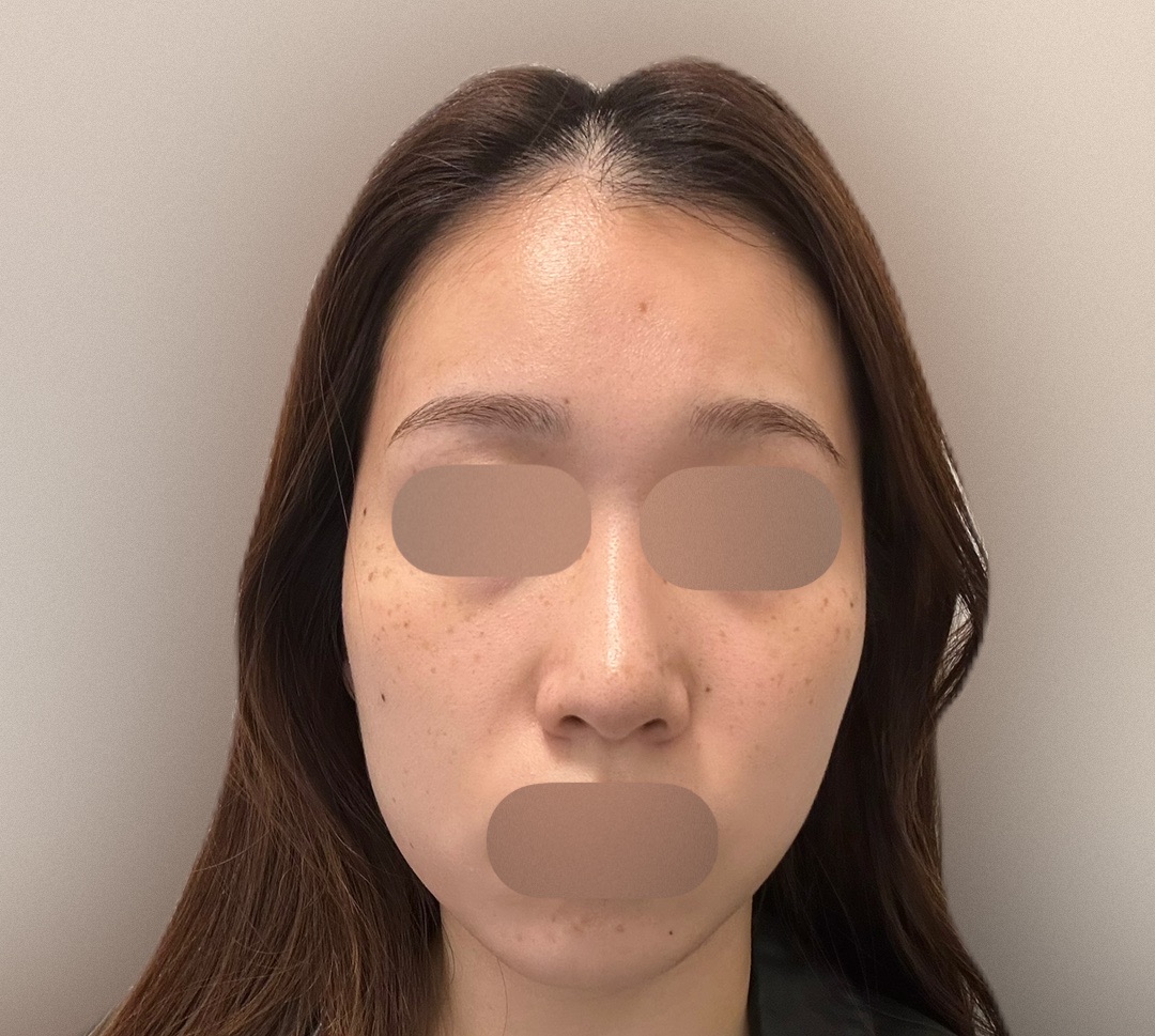 マッサージピール＋エレクトロポレーション（レナトスTA） | M's