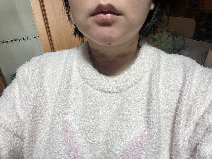 after photo: 이중턱지방흡입, 얼굴지방흡입, 볼지방흡입