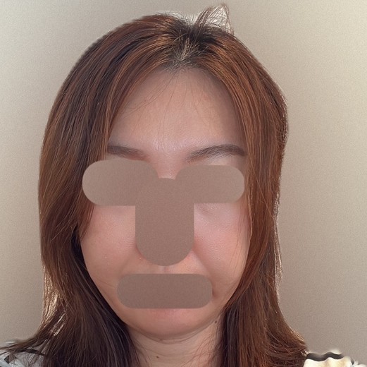 after photo: IPL(光/フォト治療), ピーリング, エレクトロポレーション