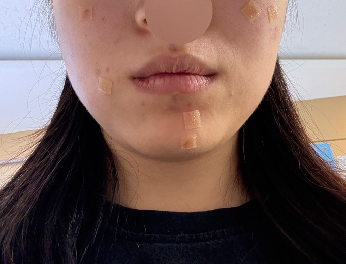 after photo: 여드름압출, 여드름주사