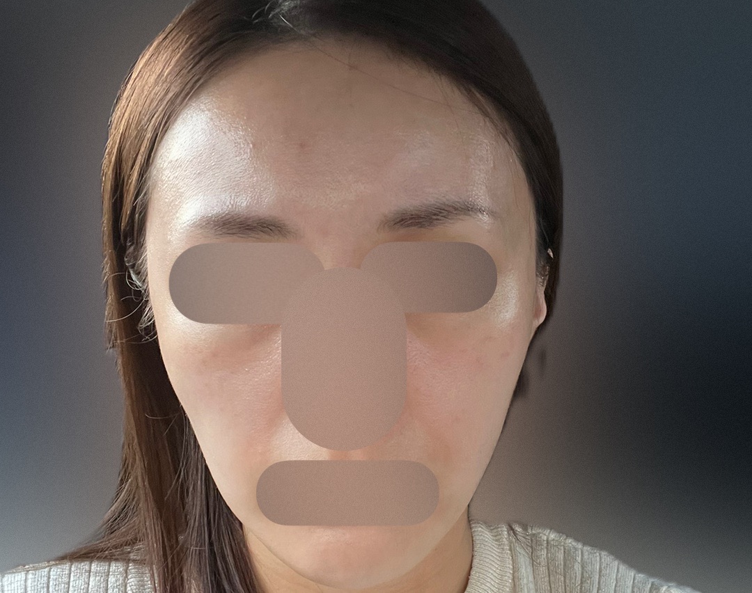 ピーリング　エレクトロポレーション エレクトロポレーション（イオン導入）｜美容皮膚科なら湘南美容