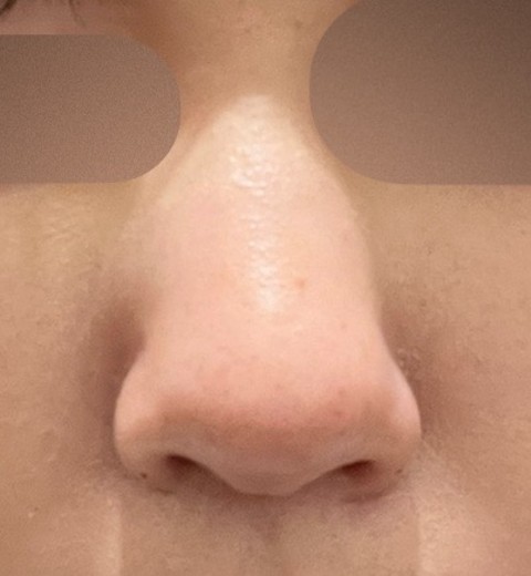 after photo: 小鼻ボトックス, 脂肪溶解注射(顔)