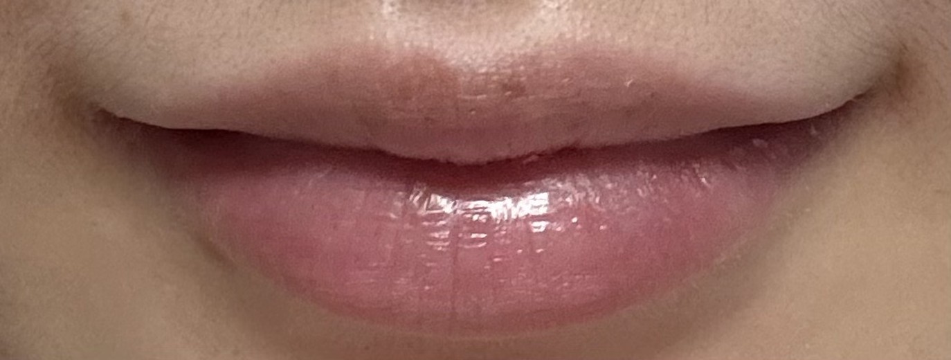 after photo: 입꼬리필러, 입꼬리보톡스, 입술필러