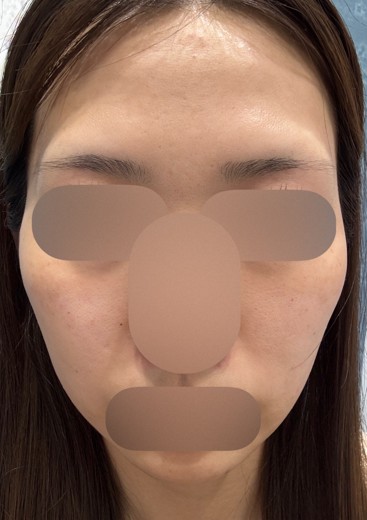 before photo: ルメッカ