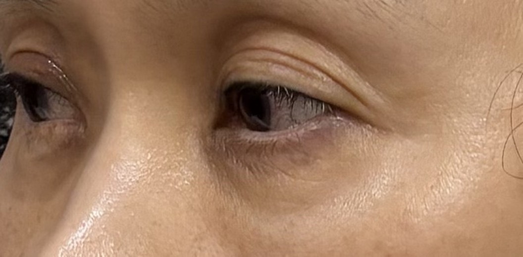 after photo: 눈밑지방재배치