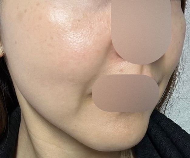 before photo: Qスイッチレーザー
