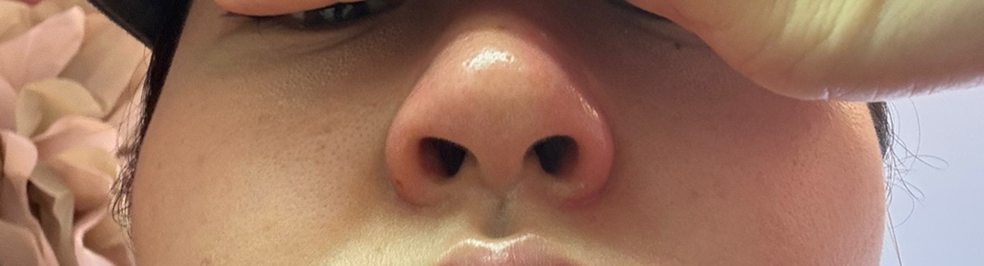 after photo: 小鼻ボトックス, 脂肪溶解注射(顔)