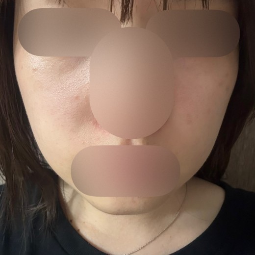 after photo: 脂肪溶解注射(顔)