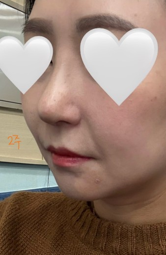 after photo: 콧대(보형물), 코끝(자가연골)