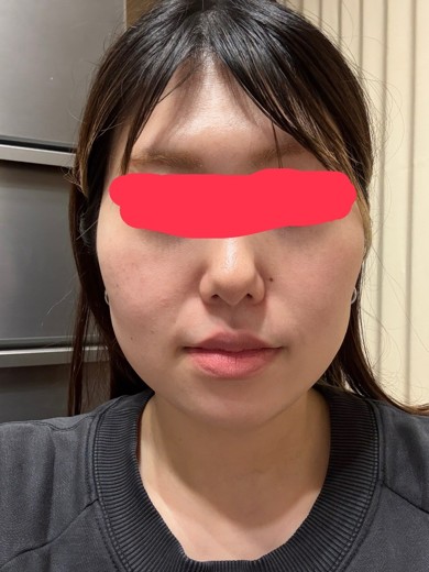 before photo: 糸リフト, 脂肪吸引(顎下), 脂肪吸引(顔), 脂肪吸引(頬)