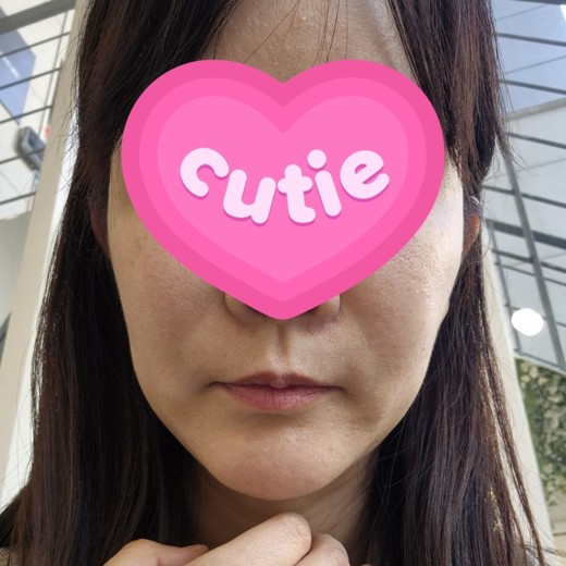 before photo: 볼필러