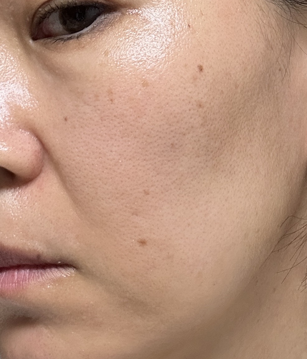 何度でも可】美顔レーザートーニング｜シミ・肝斑・毛穴・くすみ改善