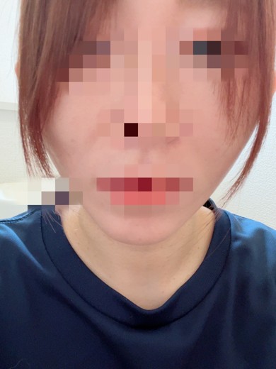 after photo: 糸リフト