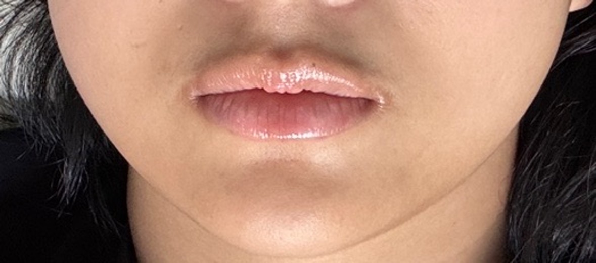 after photo: 입술필러