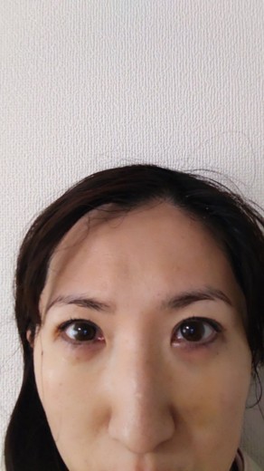 after photo: 脱脂(クマ治療)