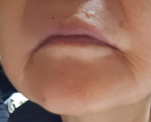 after photo: 윤곽주사, 얼굴지방분해주사