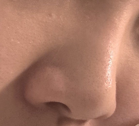 before photo: 콧대(보형물), 코끝(자가연골)