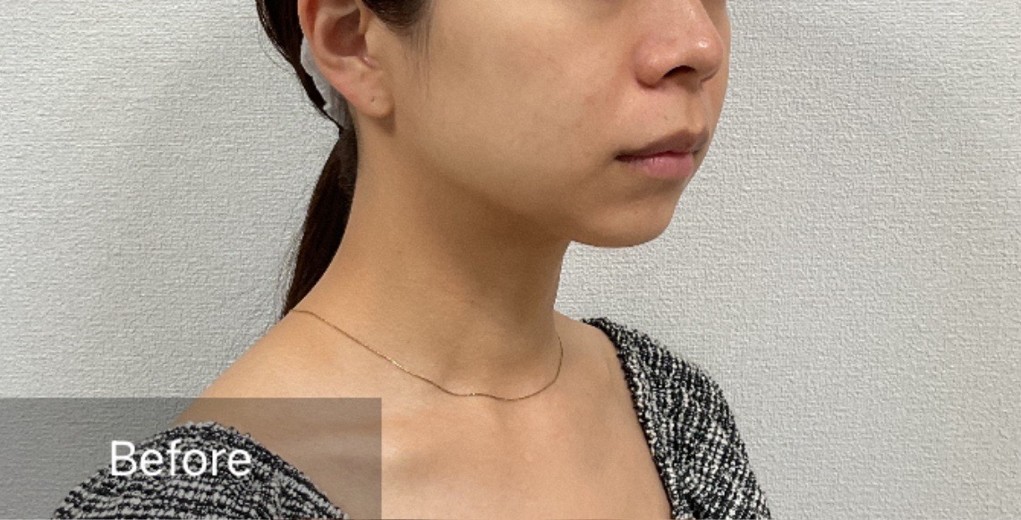 before photo: チタニウムリフト
