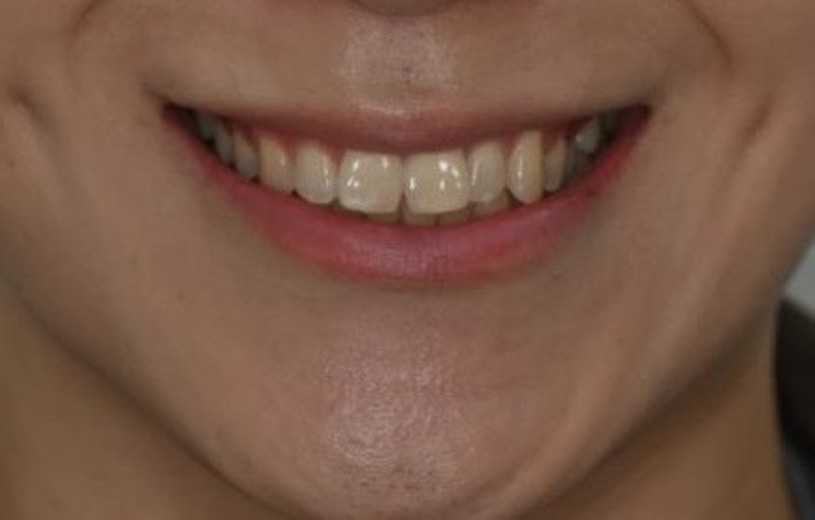 before photo: 라미네이트