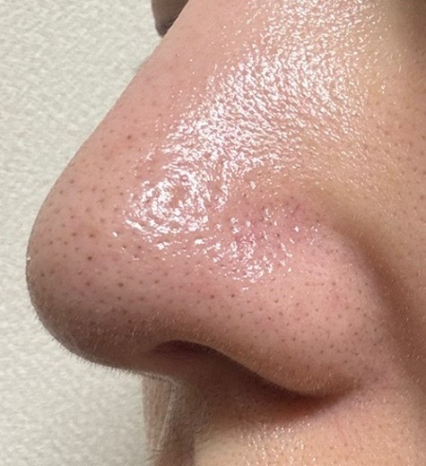 after photo: ハイドラジェントル
