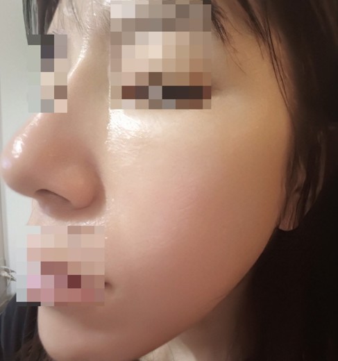 after photo: IPL(光/フォト治療), ピーリング, エレクトロポレーション