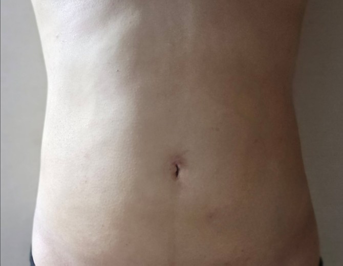 after photo: 복부지방흡입