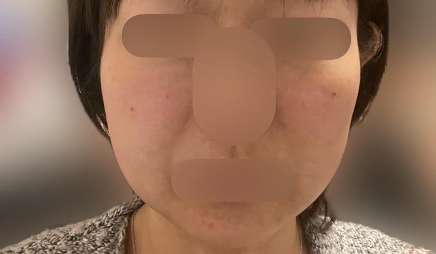 after photo: 脂肪溶解注射(顔)