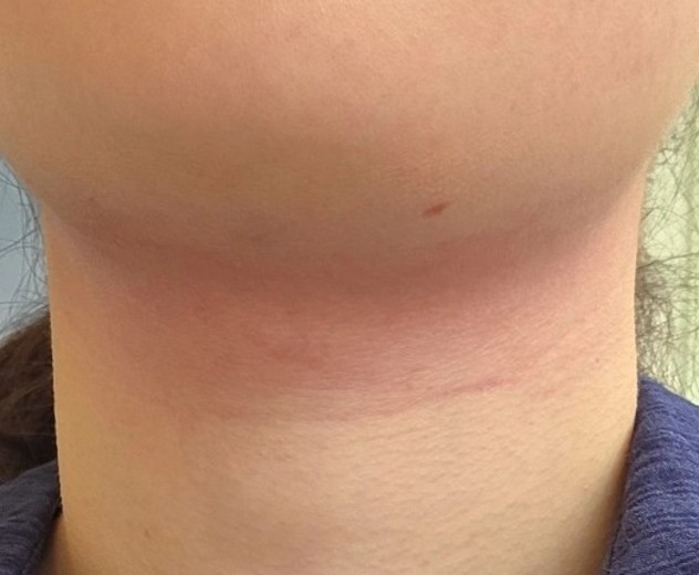 after photo: 인모드리프팅, 윤곽주사, 슈링크리프팅