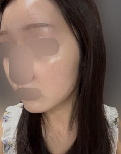 after photo: ピーリング