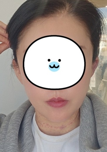 after photo: 귓볼필러