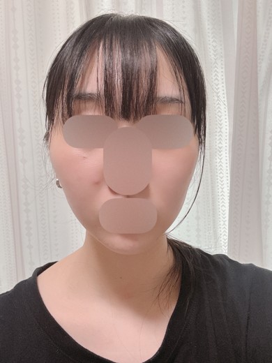 after photo: 脂肪溶解注射(顔)