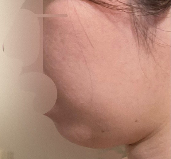 after photo: 脂肪溶解注射(顔)