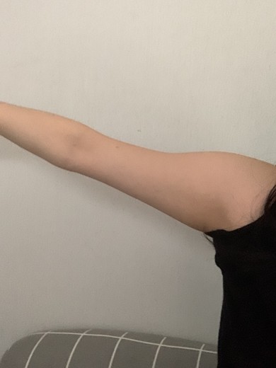 after photo: 팔지방분해주사