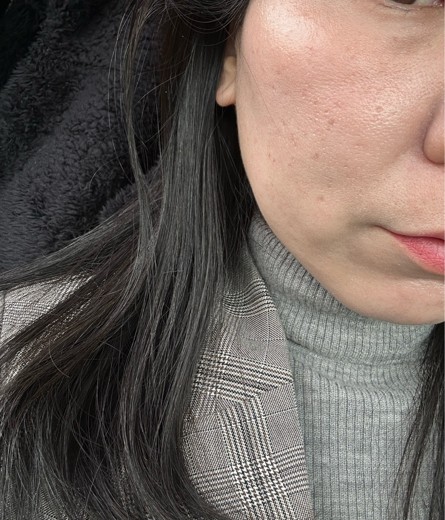 before photo: ララピール(LHAピーリング)
