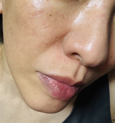 before photo: 水光注射, リジュランヒーラー, スキンボトックス