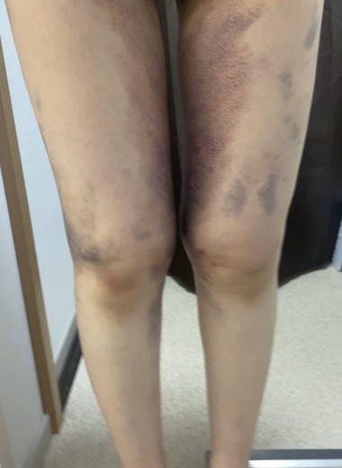 after photo: 豊胸(脂肪注入)