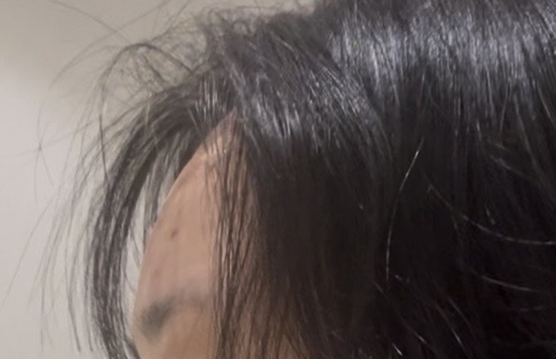 after photo: 이마필러