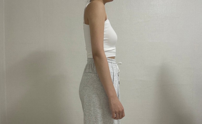 after photo: 팔지방흡입, 부유방흡입