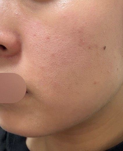 before photo: ダーマペン