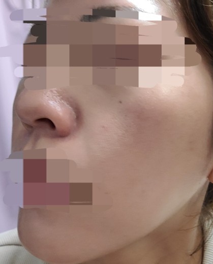 after photo: ハイドラフェイシャル, 診断・検査
