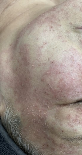 after photo: 어븀프락셀, 클라리티