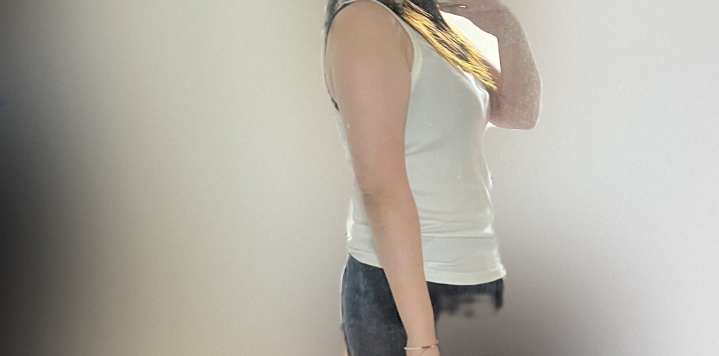 before photo: 팔지방흡입