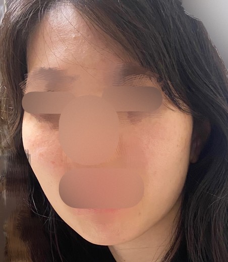 after photo: チタニウムリフト