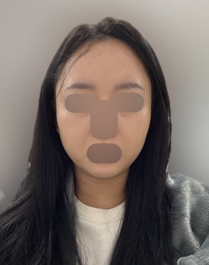 before photo: 온다리프팅