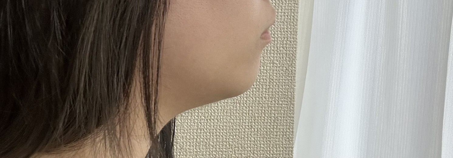 before photo: 脂肪吸引(顎下)