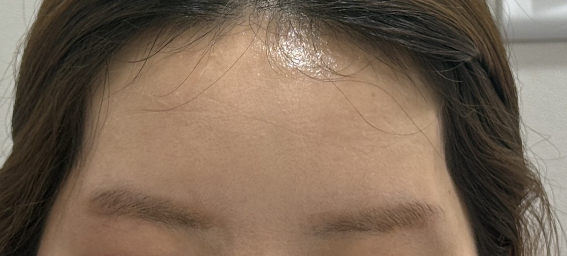 before photo: 관자놀이필러