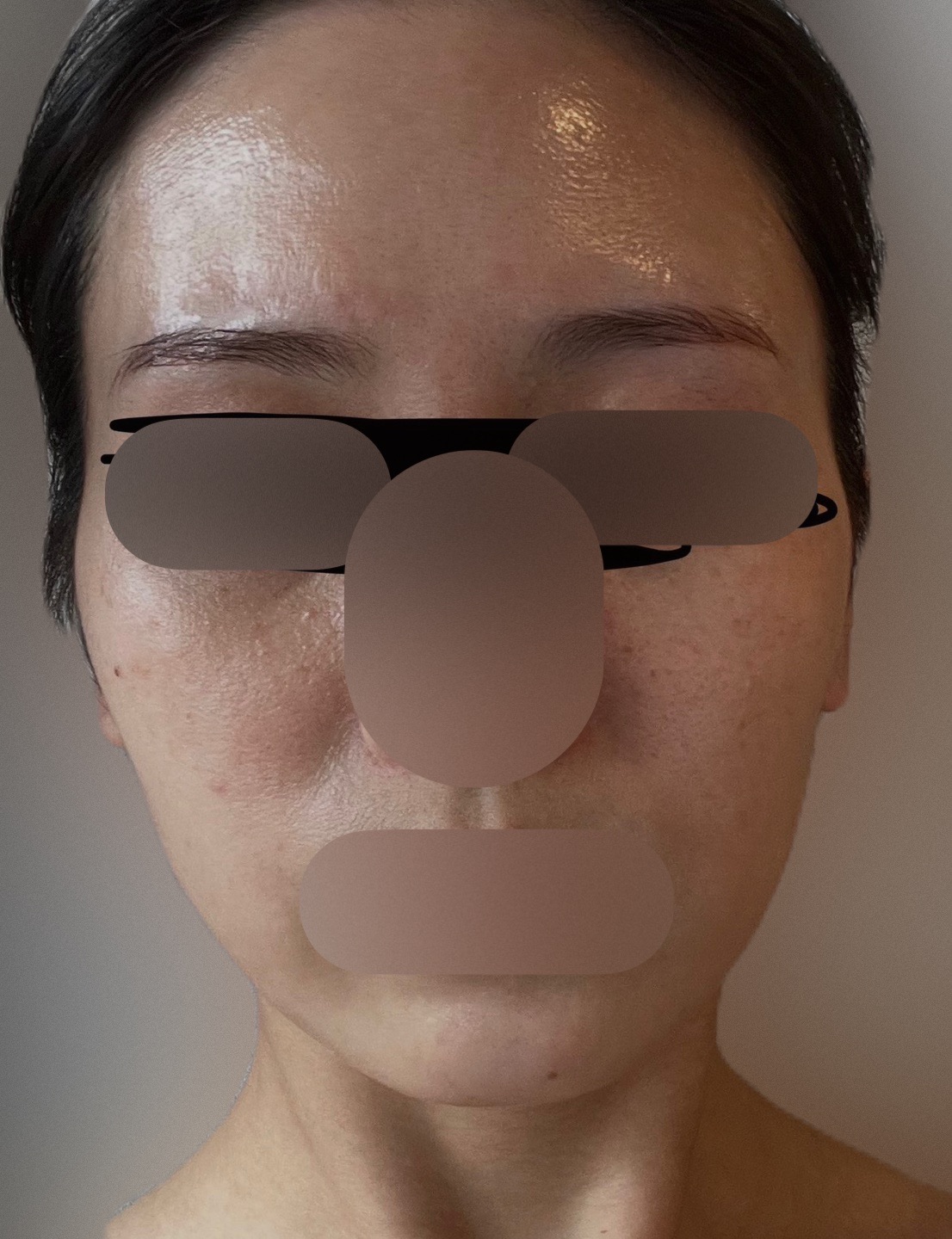 エレクトロポレーション＋ピーリング | フォンタナクリニック天神