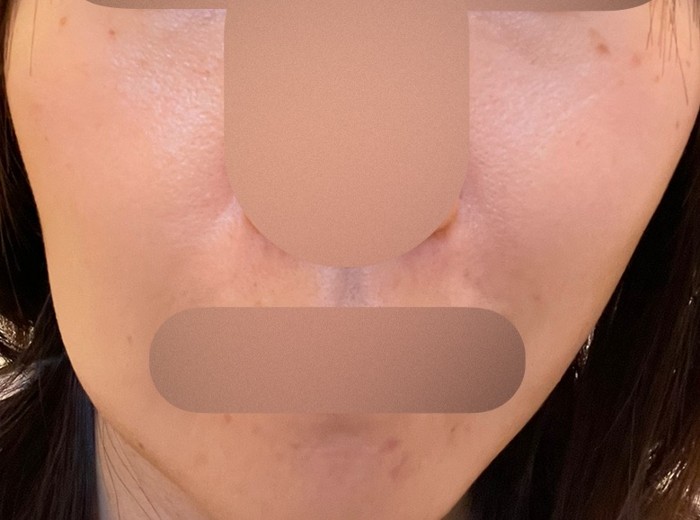 before photo: IPL(光/フォト治療)