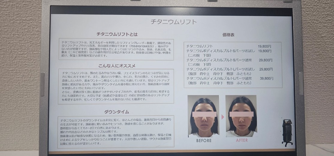 before photo: チタニウムリフト